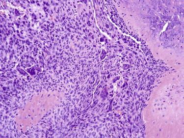 FIGURE 13-37, Giant cell tumor of soft parts. There is a proliferation of bland spindled cells, numerous osteoclasts, and often a shell of metaplastic bone. The same picture can be found in giant cell tumors of bone.