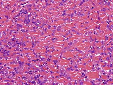 FIGURE 13-4, Interdigitation of tumor cells around collagen fibers of the reticular dermis at the periphery of a dermatofibroma.