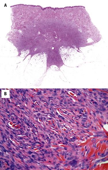 FIGURE 13-7, Cellular dermatofibroma (cellular benign fibrous histiocytoma). A, Stellate-shaped lesion that extends into the superficial subcutis along fibrous septa. B, Cellular dermatofibroma composed of dense fascicles of relatively monotonous spindle cells.