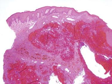 FIGURE 13-8, Aneurysmal dermatofibroma with large blood-filled spaces.