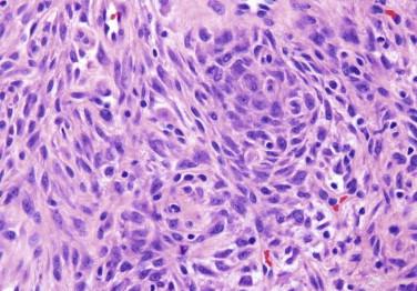 FIGURE 13-9, Epithelioid dermatofibroma characterized by the presence of round to oval (epithelioid) cells.