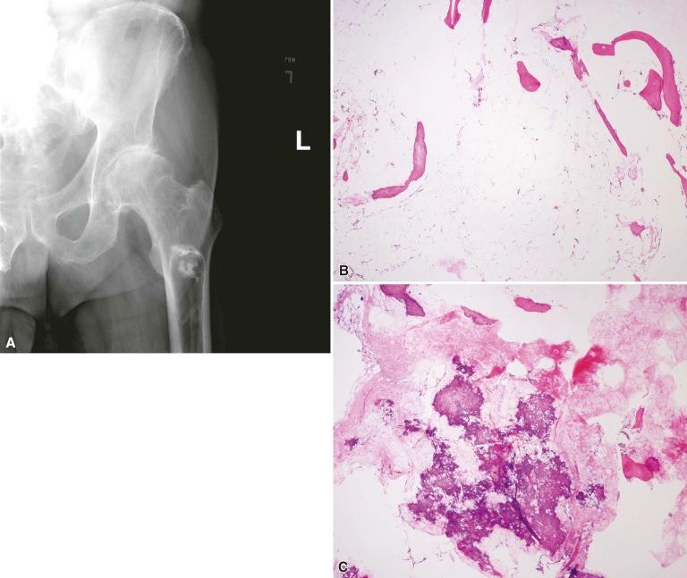 Figure 16-1, Lipoma. A, Radiograph showing an area of lucency in the proximal femoral shaft with opacification in the center (corresponding to calcification), surrounded by prominent sclerosis. B, Benign mature fat surrounding bone trabeculae. Note the absence of bone marrow elements. C, An area of fat necrosis and calcification in the same lesion depicted in B .
