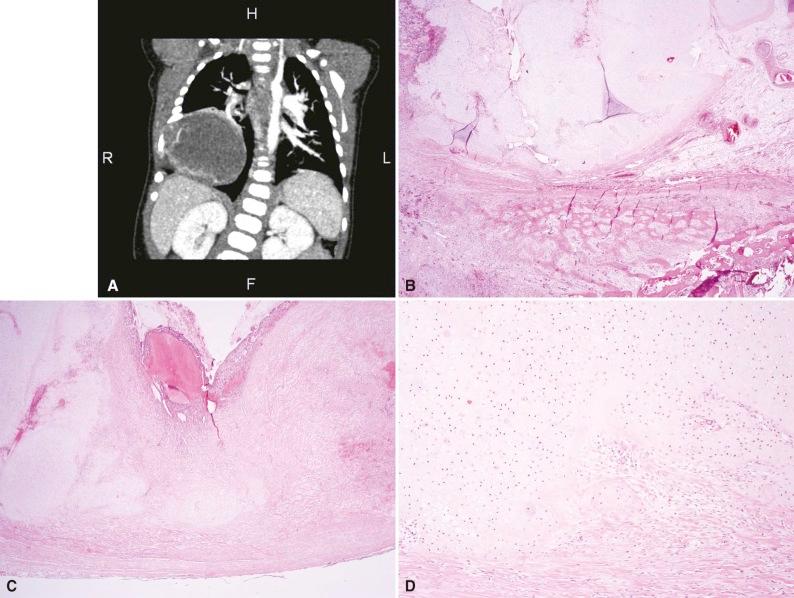 Figure 16-2, Infantile hamartoma of chest wall. A, Computed tomography image showing a cystic expansile mass with well-defined borders involving the right eighth rib. B, Section shows rib bone (bottom) with large nodules of mature hyaline cartilage arising in association with the bone. C, Aneurysmal bone cyst–like changes. D, High-power view showing benign hyaline cartilage.