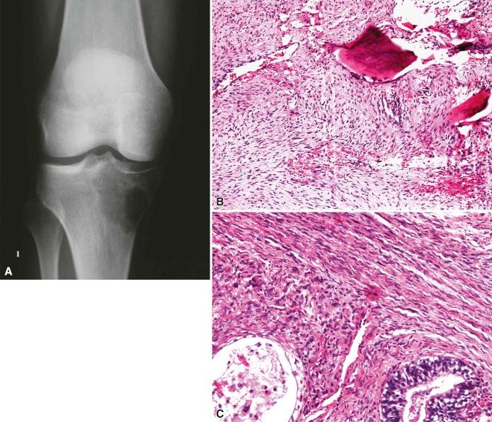 Figure 16-3, Malignant peripheral nerve sheath tumor. A, Radiograph showing a large lytic lesion involving the proximal left tibia. B, Sections show a spindle cell neoplasm with elongated nuclei and pink cytoplasm. Notice the entrapped bone trabeculae. C, Intersecting fascicles of spindle cells with wavy nuclei and focal glandular differentiation.