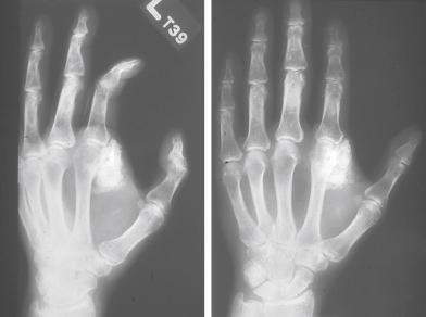 Fig. 32.1, Typical radiographic appearance of ossifying fibromyxoid tumor of soft tissue. The tumor is well circumscribed and has extensive calcification.