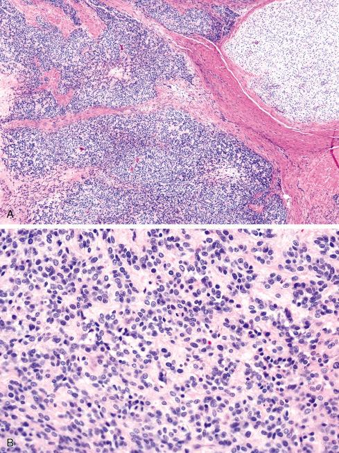 Fig. 32.11, Malignant Ossifying Fibromyxoid Tumor.