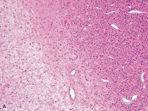 Fig. 32.12, A, Primary ossifying fibromyxoid tumor showing typical histologic features. B, In contrast, this patient’s recurrent tumor, 3 years after initial resection, showed histologic features of malignancy, including high nuclear grade, high cellularity, and elevated mitotic activity.