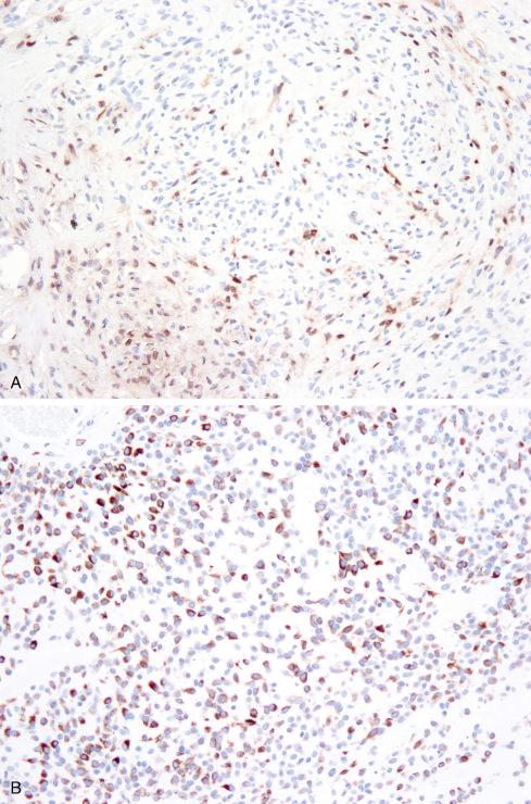 Fig. 32.13, Expression of S-100 protein ( A ), desmin ( B ), and neurofilament protein ( C ) in ossifying fibromyxoid tumor.