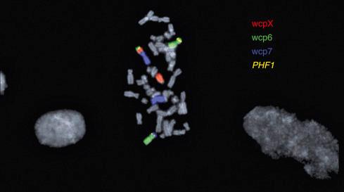 Fig. 32.14, Break-apart FISH in malignant ossifying fibromyxoid tumor, demonstrating PHF1 rearrangement.