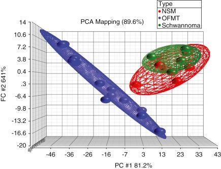 Fig. 32.16, Principal component analysis mapping of gene expression profiling data from ossifying fibromyxoid tumors compared with true nerve sheath tumors. Histologically benign and malignant OFMTs cluster together ( blue ), and apart from nerve sheath myxomas ( red ) and schwannomas ( green ).