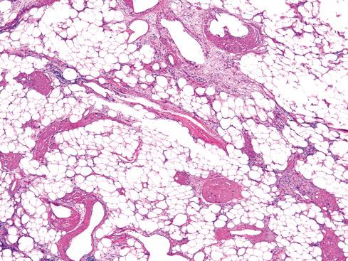 Fig. 32.17, Hemosiderotic fibrolipomatous tumor illustrating wispy proliferation of spindled cells in fat associated with some characteristic vessels.