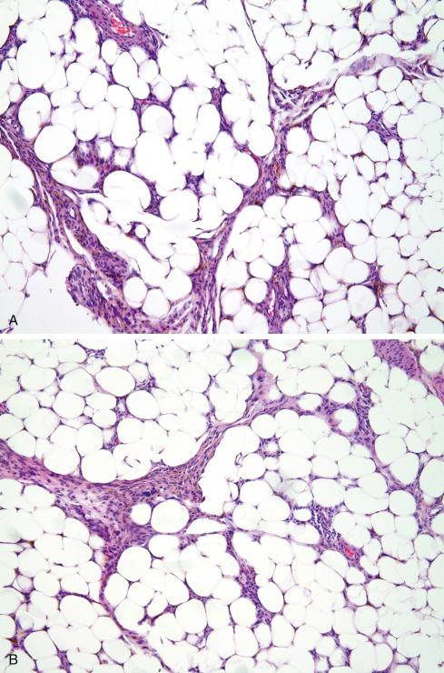 Fig. 32.18, Hemosiderotic fibrolipomatous tumor showing hemosiderin-laden spindled cells ( A ) with focal atypia infiltrating fat ( B ). “PHAT-like” vascular changes are commonly seen in HFLTs, emphasizing their close relationship to pleomorphic hyalinizing angiectatic tumor ( C ).