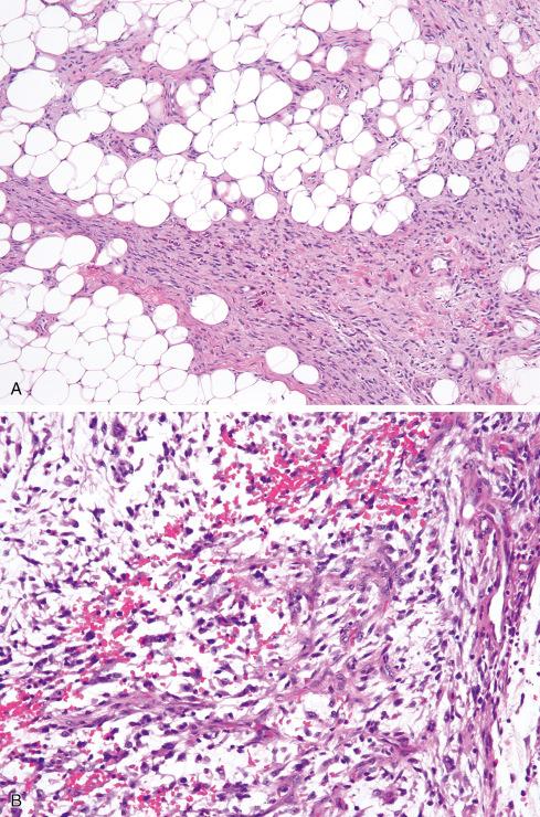 Fig. 32.19, Hemosiderotic fibrolipomatous tumor ( A ) with progression to myxoid sarcoma, so-called “hybrid hemosiderotic fibrolipomatous tumor–myxoinflammatory fibroblastic sarcoma” (B ). This tumor was positive for TGFBR3-MGEA5 rearrangement on FISH.