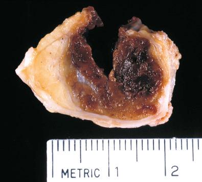 Fig. 32.20, Pleomorphic hyalinizing angiectatic tumor. Gross specimen with hemorrhagic appearance.