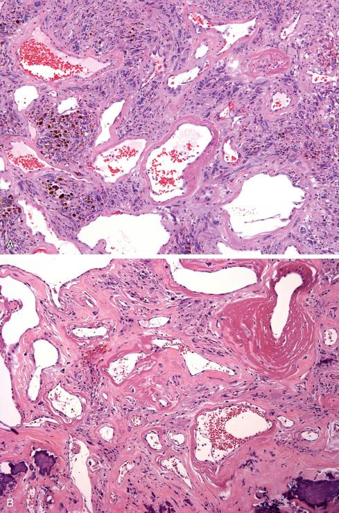 Fig. 32.21, Pleomorphic hyalinizing angiectatic tumor with clusters of thin-walled ectatic fibrin-rimmed vessels punctuating stroma that varies from cellular ( A ) to more hyalinized ( B ).