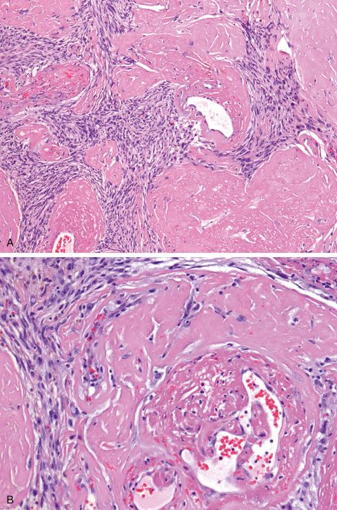 Fig. 32.22, Pleomorphic hyalinizing angiectatic tumor with fibrin lined vessels ( A ) containing organizing thrombus ( B ).