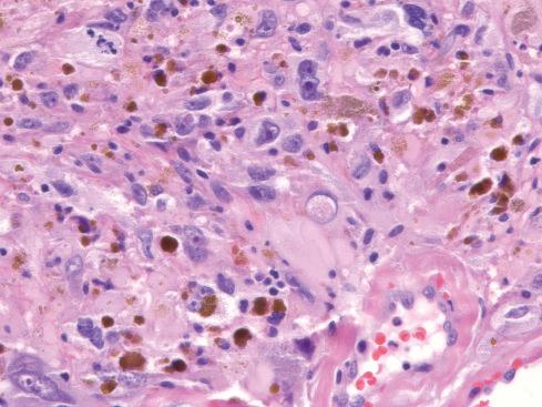 Fig. 32.24, Cells with atypia and intranuclear cytoplasmic inclusions in pleomorphic hyalinizing angiectatic tumor.