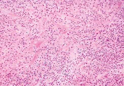 Fig. 32.3, Low-magnification view of ossifying fibromyxoid tumor showing cells arranged in various patterns and deposited in variably hyalinized and myxoid matrix.