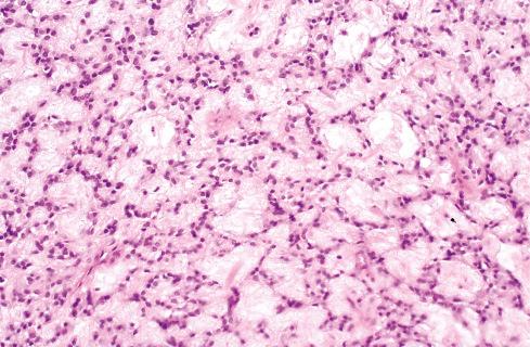 Fig. 32.4, Ossifying fibromyxoid tumor showing cords of small tumor cells suspended in myxoid matrix.