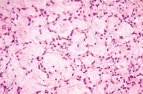 Fig. 32.6, Less cellular zone in ossifying fibromyxoid tumor.