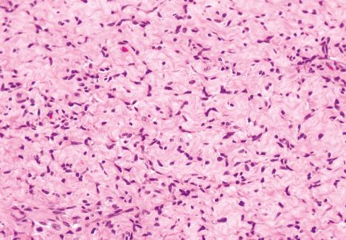 Fig. 32.7, Fibrous zone in ossifying fibromyxoid tumor, with compression of cords of tumor cells.