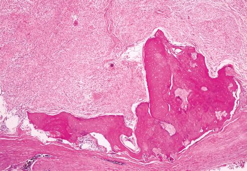 Fig. 32.8, Ossifying fibromyxoid tumor with incomplete rim of lamellar bone.