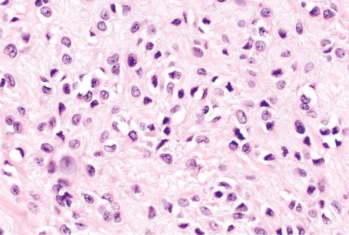 Fig. 32.9, High-magnification view of bland epithelioid cells with vacuolated or eosinophilic cytoplasm in ossifying fibromyxoid tumor.