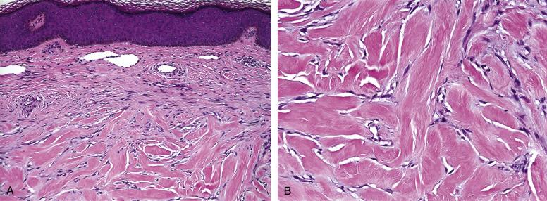 Fig. 9.1, A, Keloid, with involvement of the superficial dermis by benign-appearing fibroblastic cells, oriented parallel to the epidermal surface, with large bundles of glassy collagen occupying the deeper dermis. B, Glassy collagen bundles in a keloid, with small interposed fibroblasts.