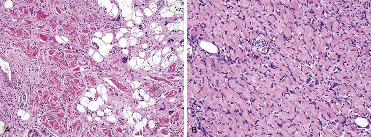 Fig. 9.11, A, Composite giant cell fibroblastoma/dermatofibrosarcoma protuberans, with areas of typical dermatofibrosarcoma (left) segueing into foci containing numerous multinucleated tumor giant cells (right) . B, Giant cell fibroblastoma, showing striking stromal hyalinization and pseudovascular clefts, lined in part by multinucleated neoplastic giant cells.