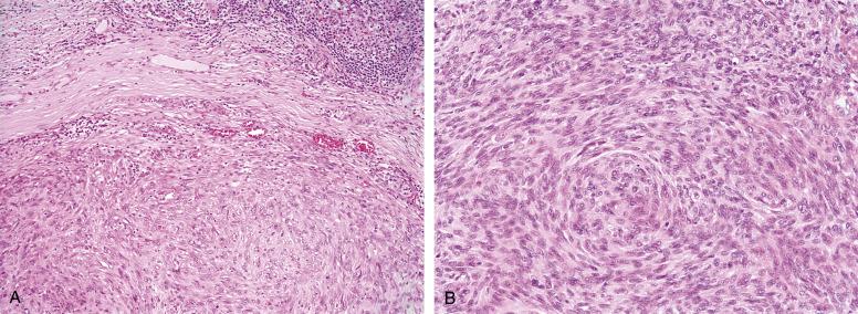 Fig. 9.12, A, Angiomatoid (malignant) fibrous histiocytoma with a dense fibrous capsule and a surrounding lymphoid infiltrate, mimicking metastasis to a lymph node. B, Meningothelial-like whorls and short fascicles of spindled to histiocytoid-appearing cells in angiomatoid (malignant) fibrous histiocytoma.