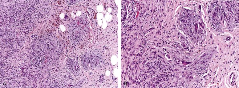 Fig. 9.13, A, Plexiform fibrohistiocytic tumor, with multiple minute nodules of histiocytes-like cells and osteoclast-like giant cells, surrounded by fascicles of spindled fibroblastic cells. B, Higher-power view of the diagnostic biphasic growth pattern displayed by plexiform fibrohistiocytic tumor.