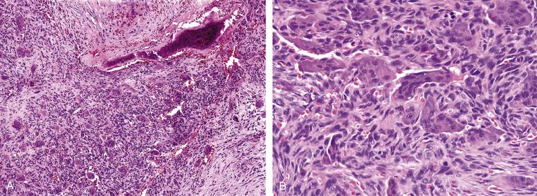 Fig. 9.14, A, Soft-tissue giant cell tumor, with a peripheral shell of reactive bone. B, Soft tissue giant cells tumors are identical to their bony counterparts, with innumerable osteoclast-like giant cells and interspersed, bland, mitotically active mononuclear cells.