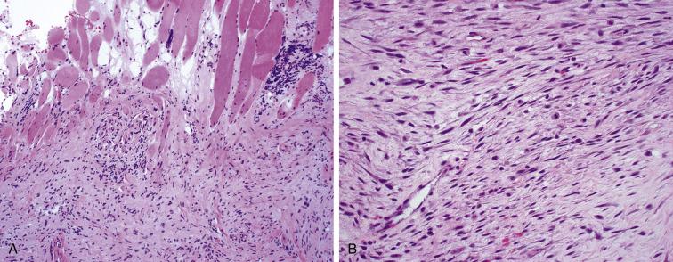 Fig. 9.15, Low-grade myofibroblastic sarcoma infiltrates muscle in a pattern reminiscent of fibromatosis (A) and exhibits mild cellular atypia in the form of nuclear enlargement, hyperchromasia, and scattered mitotic figures.