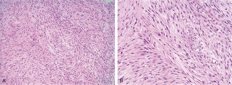 Fig. 9.16, A, “Herringbone” pattern of monomorphic, hyperchromatic spindled cells in adult-type fibrosarcoma. B, Although the cells of adult-type fibrosarcoma are hyperchromatic and mitotically active, they should not show more than moderate pleomorphism. Fibrosarcomas should be distinguished from monophasic synovial sarcomas and malignant peripheral nerve sheath tumors, with immunohistochemistry for cytokeratins and S100 protein, and with cytogenetic or molecular genetic testing for the synovial sarcoma-associated t(X;18).