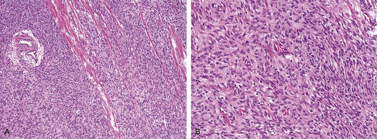 Fig. 9.17, A, Infantile fibrosarcoma, diffusely infiltrating skeletal muscle. B, The neoplastic cells of infantile fibrosarcoma are usually smaller than those of adult fibrosarcoma, with a high nuclear to cytoplasmic ration, and are associated with numerous small lymphocytes.