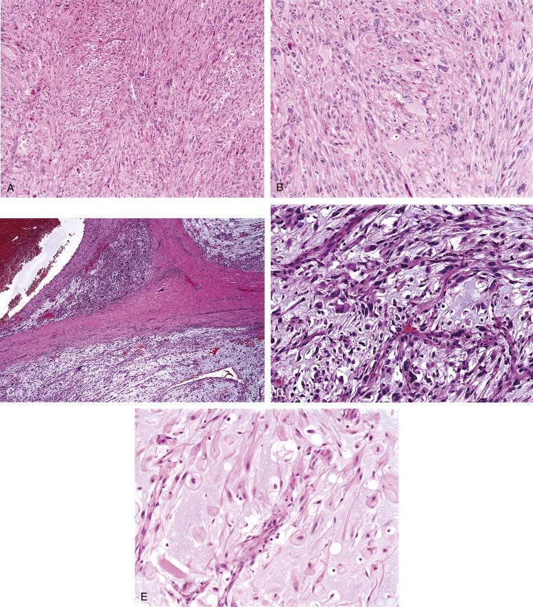 Fig. 9.18, A, Undifferentiated pleomorphic sarcoma, consisting of highly pleomorphic spindled cells in a variably collagenous background. B, Marked cytologic pleomorphism in undifferentiated pleomorphic sarcoma. C, Myxofibrosarcoma typically grows as a multinodular mass, with juxtaposed myxoid and solid nodules. D, High-grade myxofibrosarcoma, with strikingly pleomorphic tumor cells radiating from a thick-walled blood vessel. E, Low-grade myxofibrosarcoma containing relatively bland spindled cells and numerous tumor cells distended with myxoid substance (pseudolipoblasts).