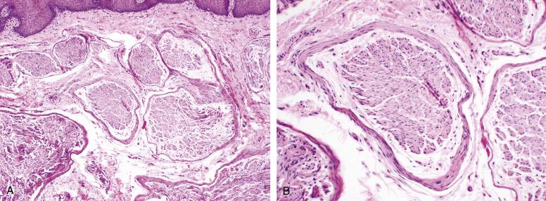 Fig. 9.20, Mucosal neuroma.