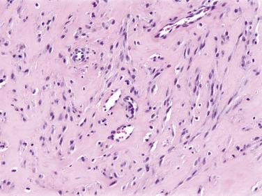 Fig. 9.2, Juvenile hyaline fibromatosis, consisting of mats of hyalinized collagen, with bland, epithelioid fibroblasts, surrounded by an artefactual halo.