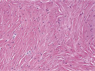 Fig. 9.3, Nuchal fibroma, with disorderly bundles of mature collagen and interspersed small fibroblasts.