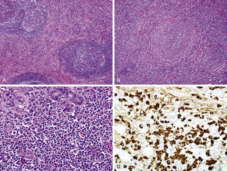 Fig. 9.4, Immunoglobulin (Ig)G4-related fibrosclerosing lesions demonstrate cellular fibrosis in a storiform pattern, with associated chronic inflammation with germinal centers (A). Obliterative phlebitis (center) is a characteristic feature (B). The chronic inflammatory infiltrate is predominated by plasma cells (C), many of which are positive for IgG4, by immunohistochemistry (D).