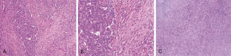 Fig. 9.5, A, Myofibroma, showing a biphasic growth pattern, with fascicles of myoid-appearing spindled cells surrounding nodules of rounded, pericyte-like cells. B, Higher-power view of myoid spindled cells and more primitive-appearing round cells. C, Cellular myofibroma, consisting chiefly of a fascicular proliferation of myofibroblastic spindled cells.