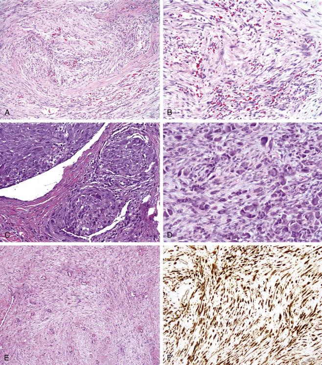 Fig. 9.6, A, Nodular fasciitis, consisting of bland myofibroblastic cells arranged in short fascicles, with prominent microcystic change. B, “Tissue culture”–like myofibroblasts in nodular fasciitis. C, Intravascular nodular fasciitis, displaying an intravascular proliferation of myofibroblasts and osteoclast-like giant cells. D, Proliferative fasciitis, characterized by an admixture of spindled and ganglion-like myofibroblasts. E, The morphological features of cranial fasciitis are generally similar to those of nodular fasciitis, although longer fascicles may be present. F, Aberrant nuclear accumulation of β-catenin protein may be seen in cranial fasciitis.