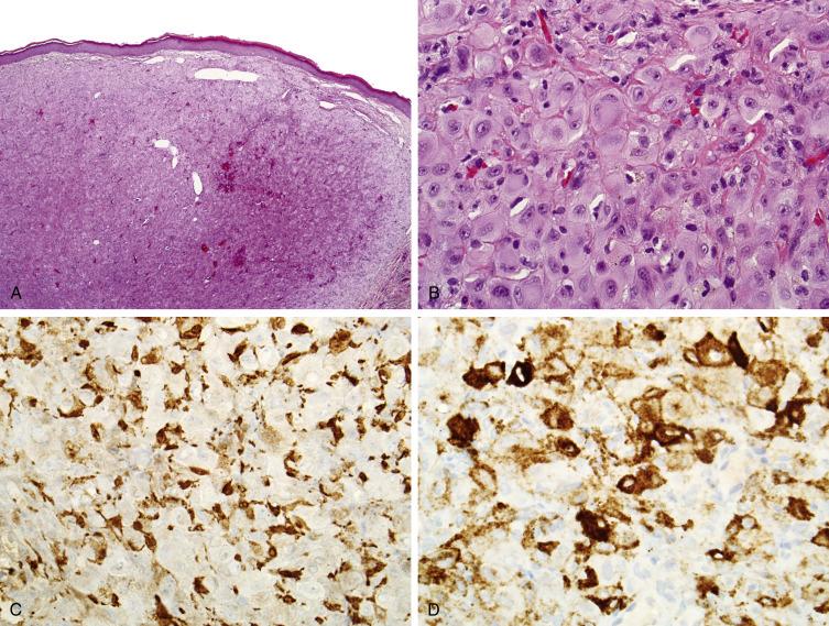 Fig. 9.7, Epithelioid fibrous histiocytoma is a circumscribed dermal-based nodule (A) composed of >50% polygonal epithelioid cells, with abundant eosinophilic cytoplasm and nuclei with vesicular chromatin and a prominent nucleolus (B). The tumor is positive for Factor XIIIa (C) and ALK1 (D).