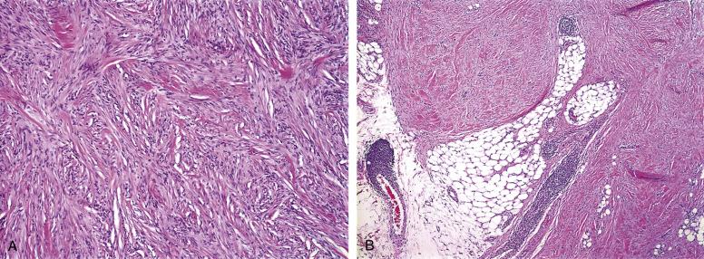 Fig. 9.8, A, Cellular benign fibrous histiocytoma, with interlacing fascicles of lightly eosinophilic cells, bundles of hyalinized collagen, and a sparse chronic inflammatory cell infiltrate. B, Limited infiltration of subcutaneous fat in cellular benign fibrous histiocytoma. The “honeycomb” pattern of fat infiltration characteristic of dermatofibrosarcoma protuberans is absent.