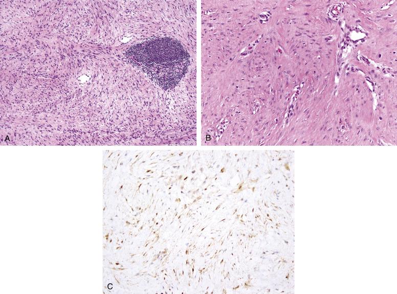 Fig. 9.9, A, Desmoid-type fibromatosis, showing long, sweeping fascicles of fibroblastic cells arrayed about small, dilated blood vessels. Small aggregates of chronic inflammatory cells are commonly present in fibromatoses. B, Higher-power view of desmoid-type fibromatosis, with abundant mature collagen, bland fibroblastic cells, and small blood vessels. C, Aberrant nuclear accumulation of β-catenin protein in desmoid-type fibromatosis.