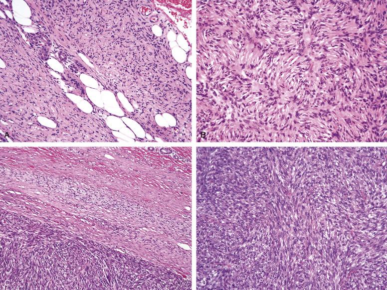 Fig. 9.10, A, Dermatofibrosarcoma protuberans, consisting of a distinctly storiform proliferation of lightly staining, monomorphic spindled cells, with diffuse infiltration of adipose tissue. B, Storiform growth in dermatofibrosarcoma protuberans. C, Abrupt transition between typical dermatofibrosarcoma protuberans (top) and fibrosarcomatous dermatofibrosarcoma protuberans (bottom) . Note the much greater cellularity and fascicular growth shown by the fibrosarcomatous component. D, Fibrosarcomatous change in dermatofibrosarcoma protuberans, with hypercellularity, greatly increased cytologic atypia, and mitotic activity.