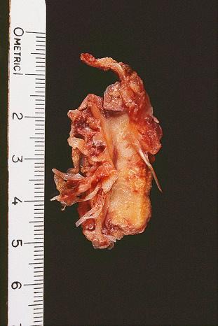 Figure 41.1, Gross appearance of calcifying aponeurotic fibroma. The mass is unencapsulated and ill defined.