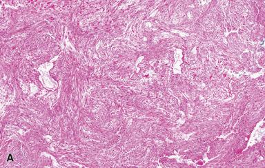 Figure 41.11, Nodular Fasciitis.