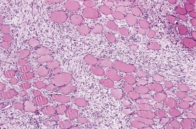 Figure 41.14, Low-power checkerboard appearance of proliferative myositis.