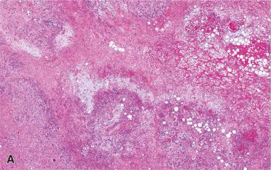 Figure 41.16, Ischemic Fasciitis.